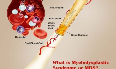 what-myelodysplastic-syndrome (1)