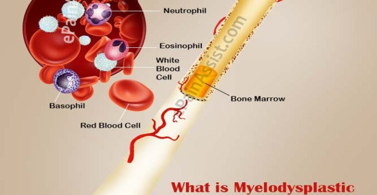 what-myelodysplastic-syndrome (1)