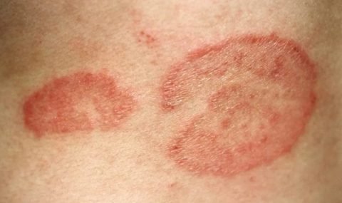 Tinea-ringworm-fungal-infection-dadar-treatment-kudasan-gandhinagar-1024x575